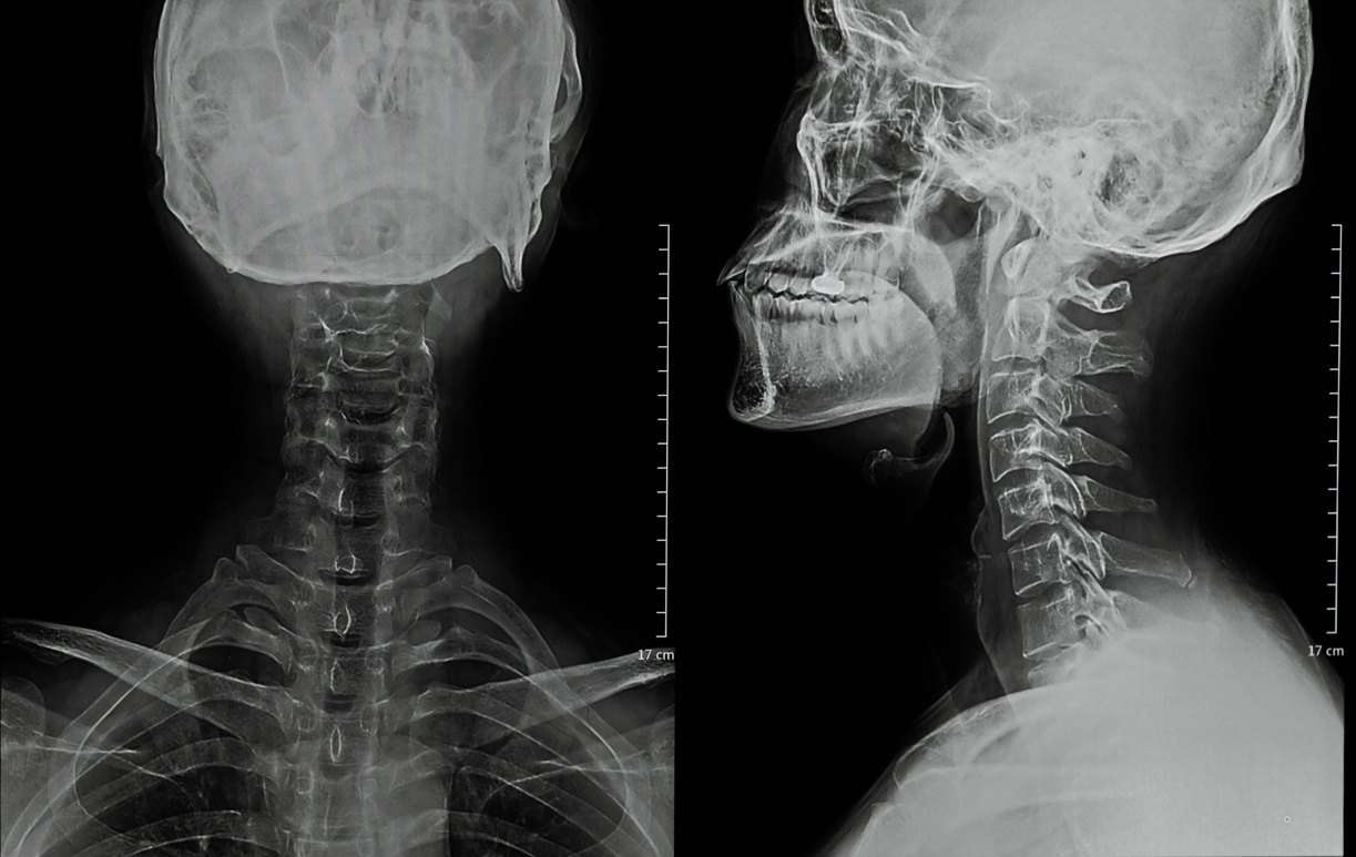 Human Neck X-Ray